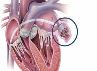 La fibrilación auricular puede afectar la salud del corazón e incluso provocar insuficiencia cardíaca