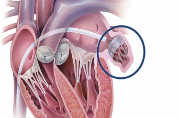 La fibrilación auricular puede afectar la salud del corazón e incluso provocar insuficiencia cardíaca