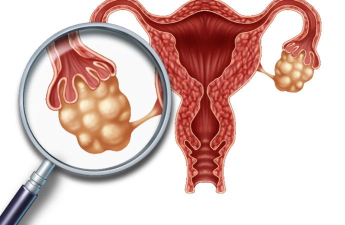 8 de mayo – Día Mundial del Cáncer de Ovario