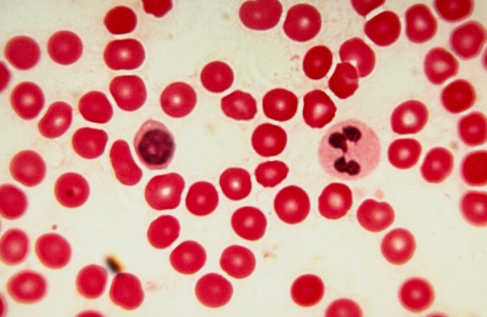 La farmacéutica Janssen presentó resultados esperanzadores para los pacientes de cánceres en la sangre