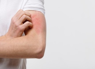 El estrés desencadena y perpetúa la dermatitis atópica hasta en un 50% de los pacientes