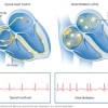 Expertos de Mayo Clinic explican la Fibrilación Auricular