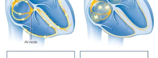 Expertos de Mayo Clinic explican la Fibrilación Auricular